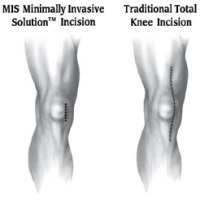 Knee Mini-Incision